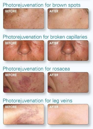 ipl-before-after_copy-161202-5841933568a9e.jpg